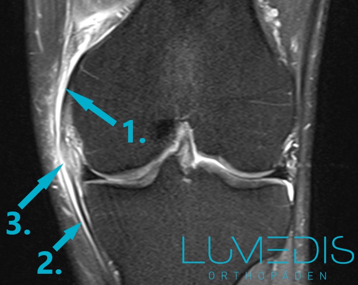 MRT eines Innenbandrisses