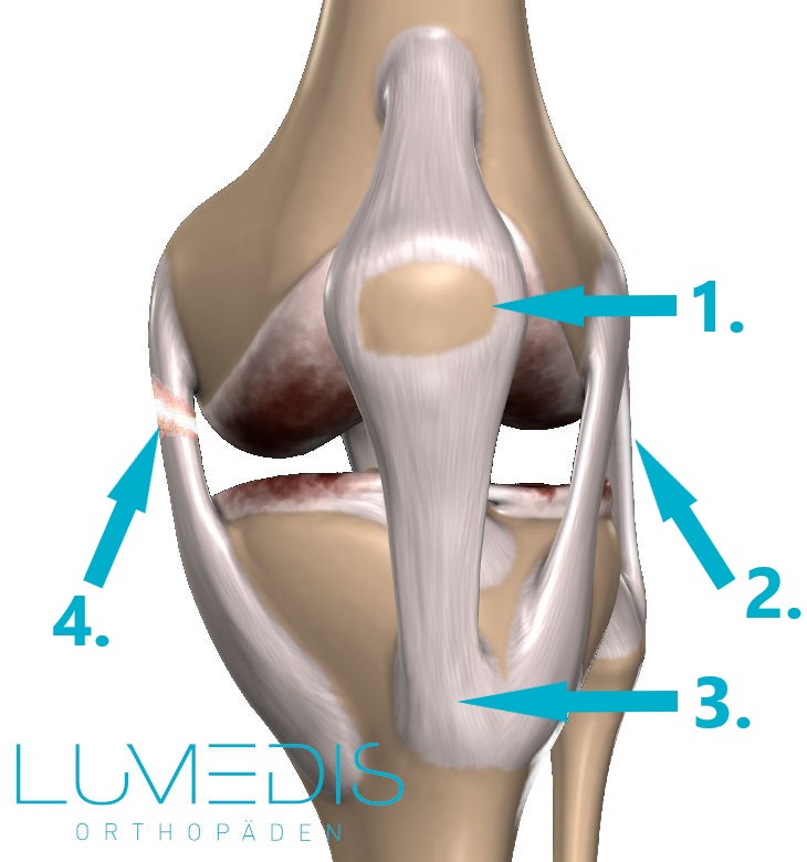 Innenbandriss Knie