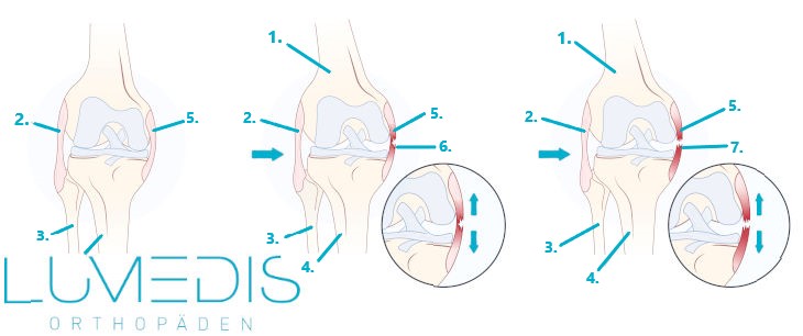 Abbildung Innenbandriss / Innenbandteilriss Knie