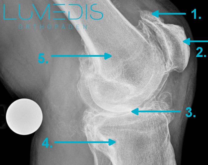 Röntgenbild einer Kniearthrose (seitlich)