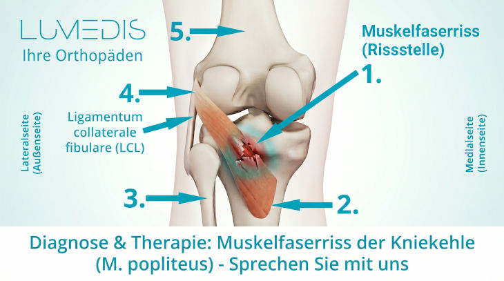 Muskelfaserriss in der Kniekehle
