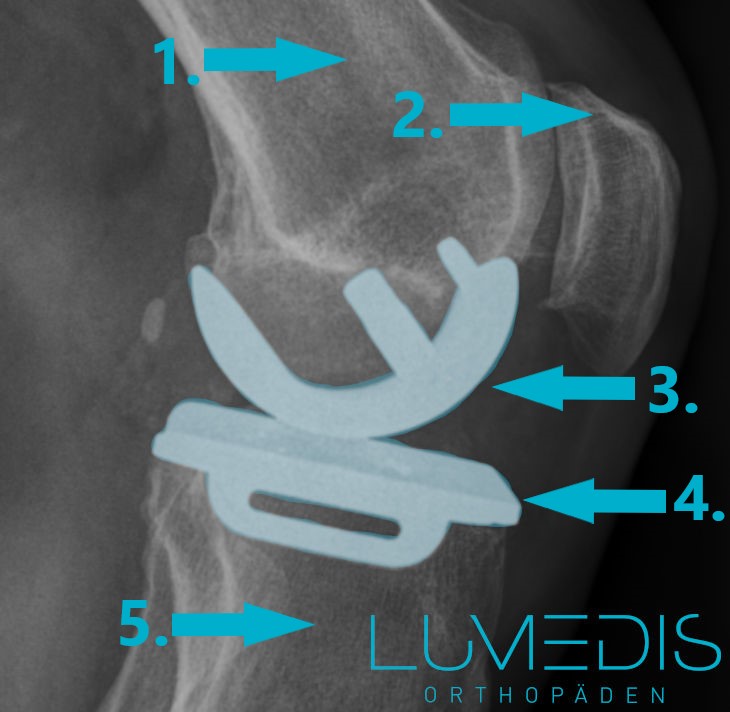 Lange schlittenprothese krank wie knie Wie Lange