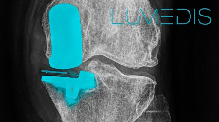 Röntgenbild einer medialen Schlittenprothese