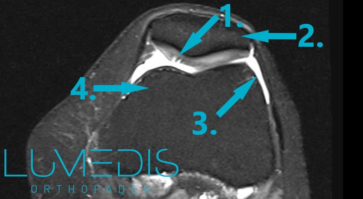 Knorpelschaden hinter der Kniescheibe