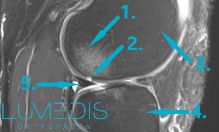 MRT Knie mit 4° Knorpelschaden