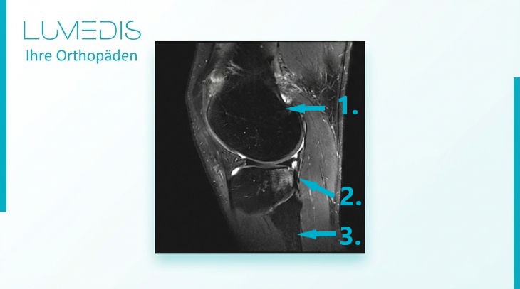 Bone bruise bei einem vorderen Kreuzbandriss (Tibiaplateau hinten außen) Bone bruise bei einem vorderen Kreuzbandriss (Tibiaplateau hinten außen)