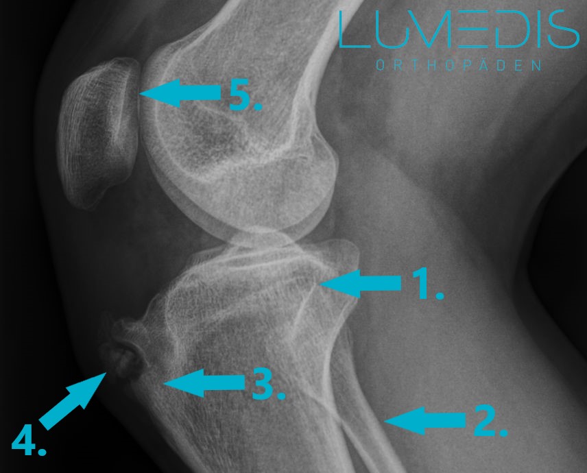 Röntgenbild Morbus Schlatter