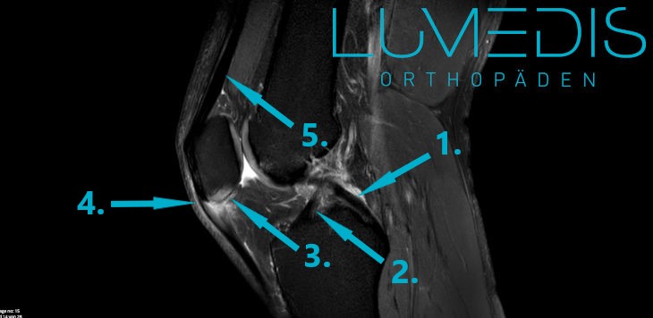 MRT einer Entzündung der Patellasehne
