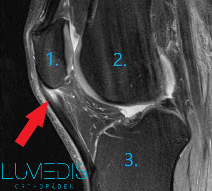 Knie dauer innenbandzerrung Außenbandzerrung knie