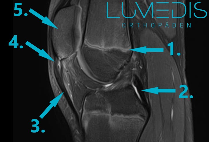 MRT eines Patellaspitzensyndroms bei einem Jugendlichen MRT eines Patellaspitzensyndroms bei einem Jugendlichen