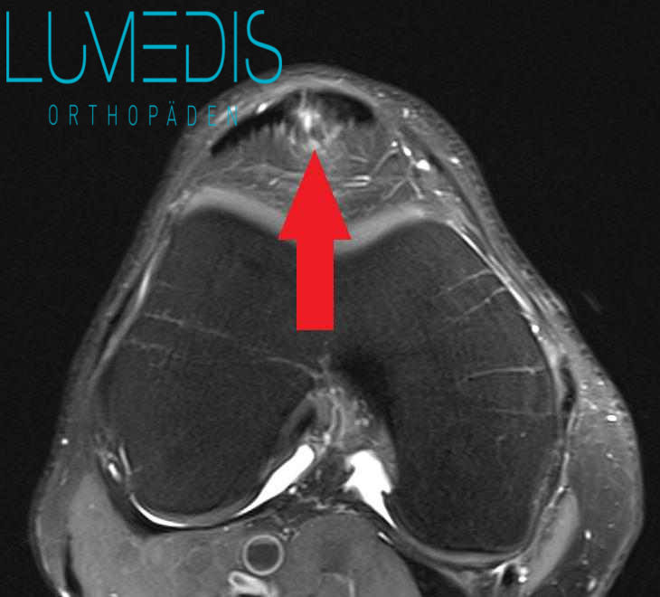Teilriss einer Patellarsehne im MRT