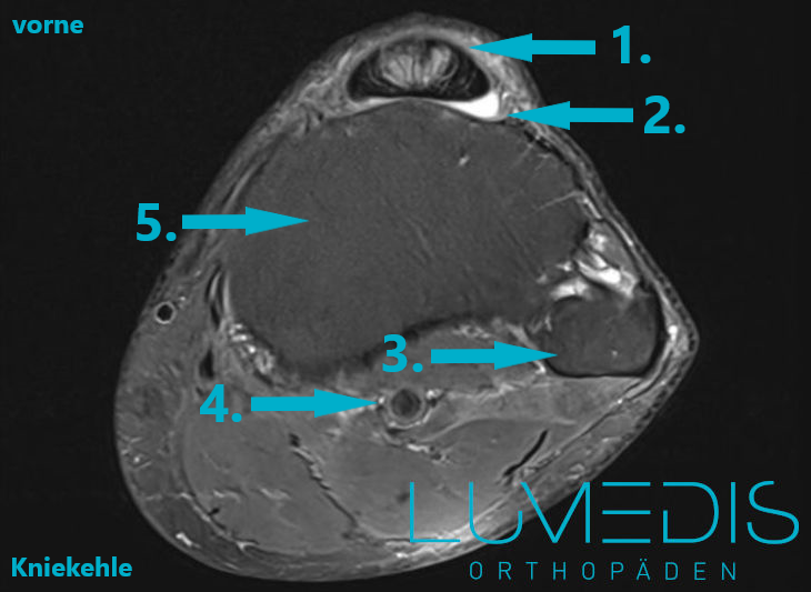 Entzündung der Patellasehne