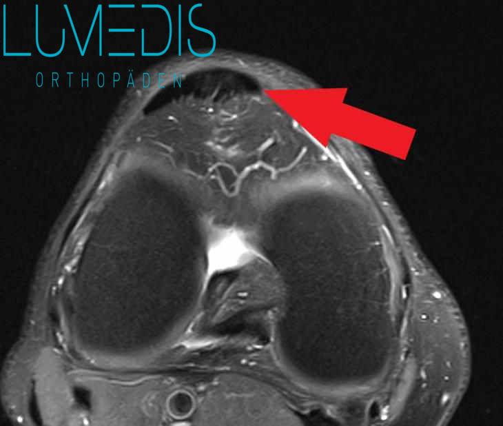 gesunde Patellasehne im MRT