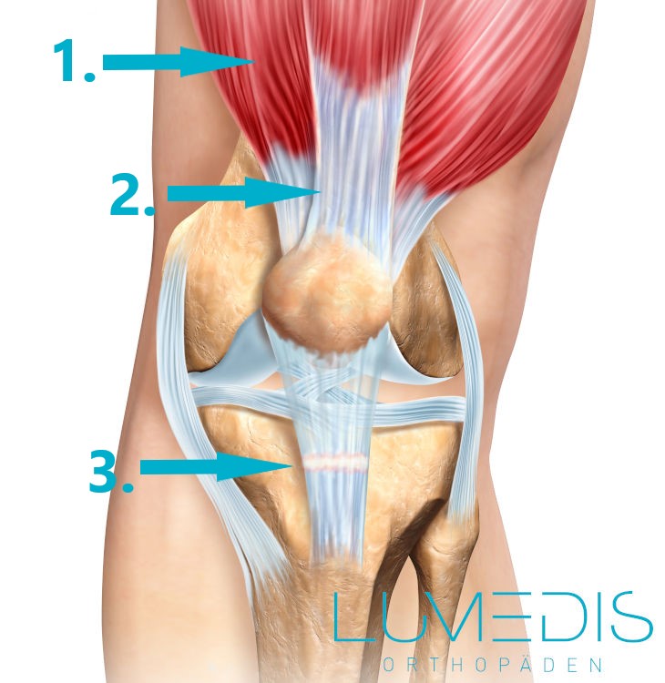 Abbildung einer Patellasehnenruptur am rechten Kniegelenk