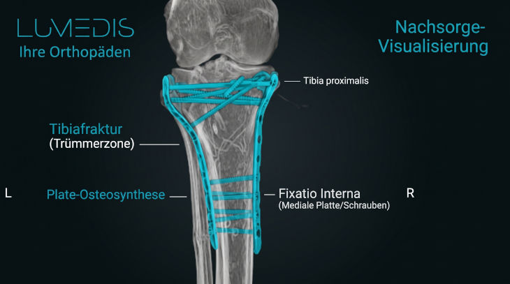CT-Bild zeigt eine Tibiafraktur mit Osteosynthese