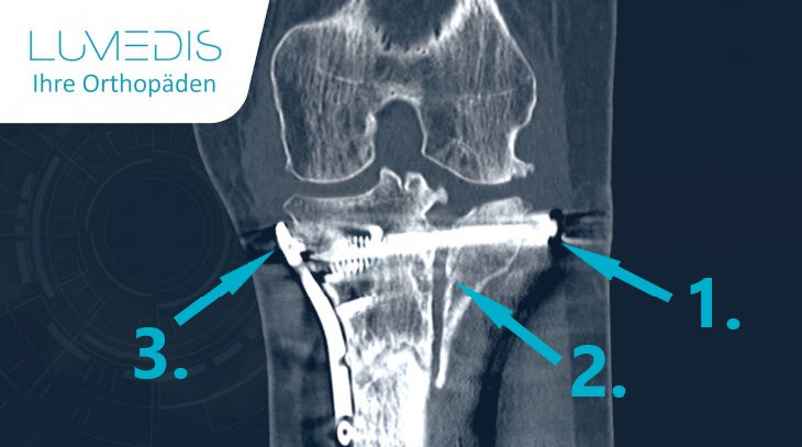 Pseudarthrose nach Tibiakopffraktur