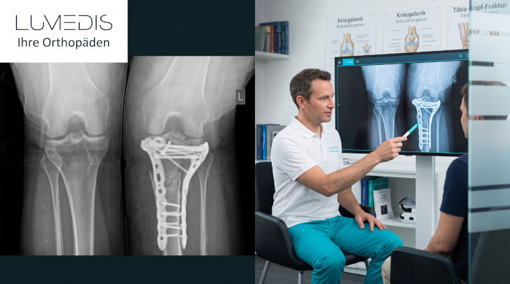 Behandlung einer Tibiakopffraktur bei Lumedis