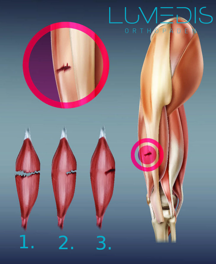 Muskelfaserriss - Lumedis - Orthopäden