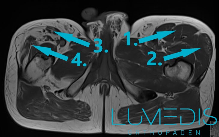 MRT Oberschenkel: Atrophie des M. rectus femoris rechts