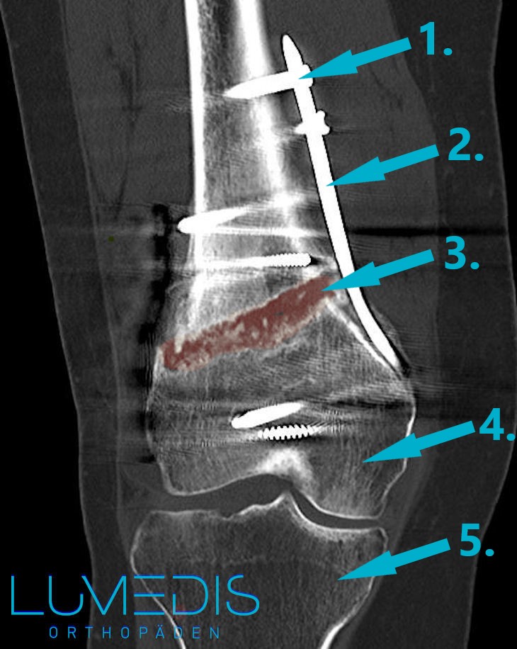 Röntgenbild des Oberschenkelknochens mit Bruch und Platte und Schrauben
