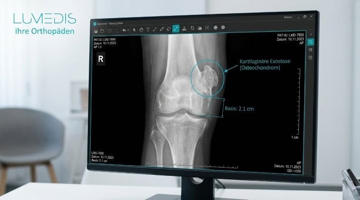 Kartilaginäre Exostose am Oberschenkelknochen