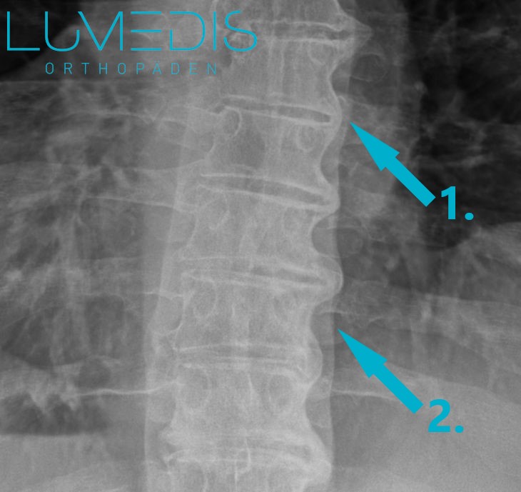 Röntgenbild eines Morbus Bechterew mit Bambusstab