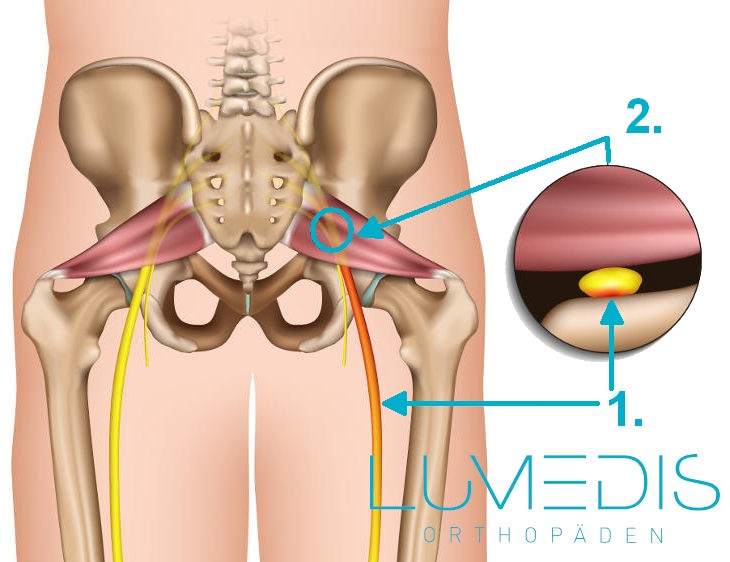 Piriformis-Syndrom