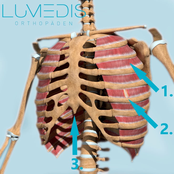 Muskelfaserriss zwischen den Rippen
