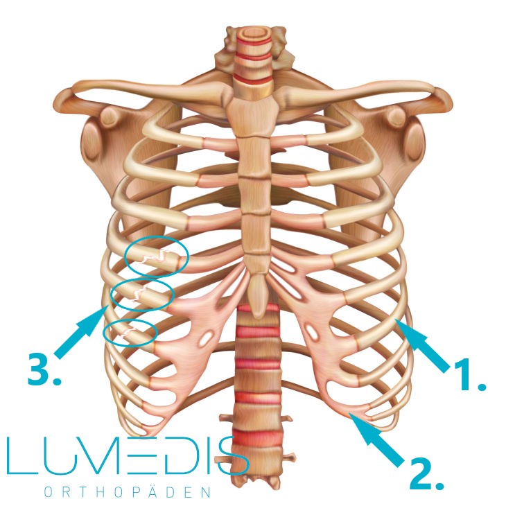 Abbildung eines Rippenbruchs