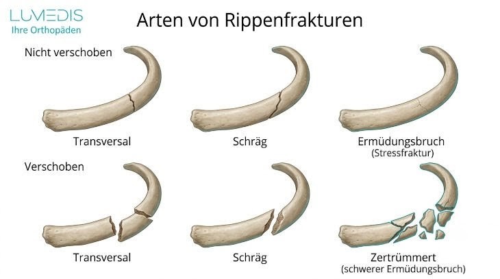Arten von Rippenbrüchen