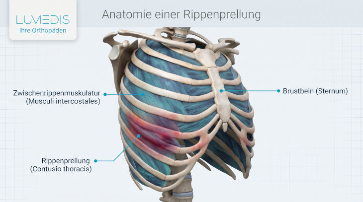 Rippenprellung
