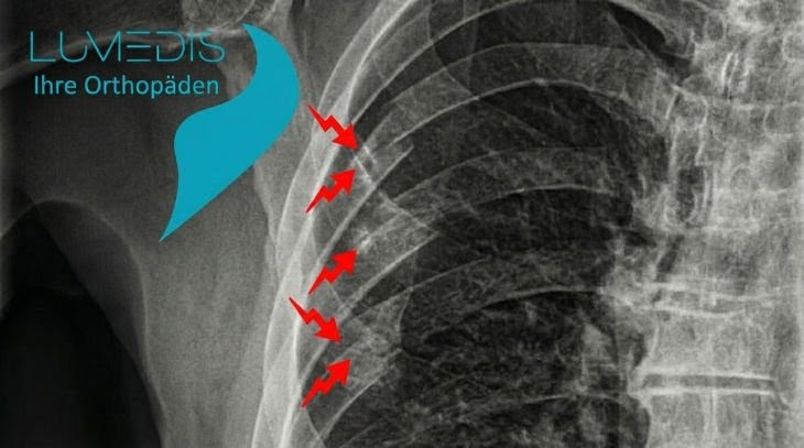 Rippenserienfraktur Rippenserienfraktur