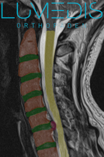 Bandscheibenvorfall der HWS