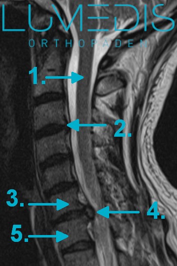 Bandscheibenvorfall der HWS mit Beschreibung