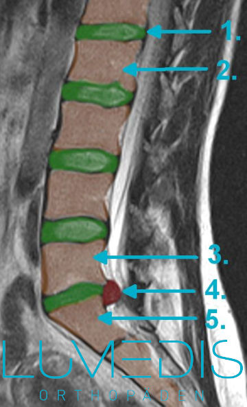 Bandscheibenvorfall L5/S1