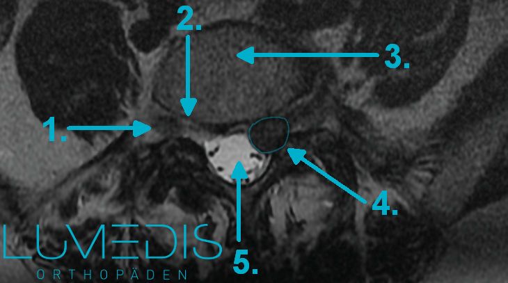 MRT Bandscheibenvorfall L5/S1 links