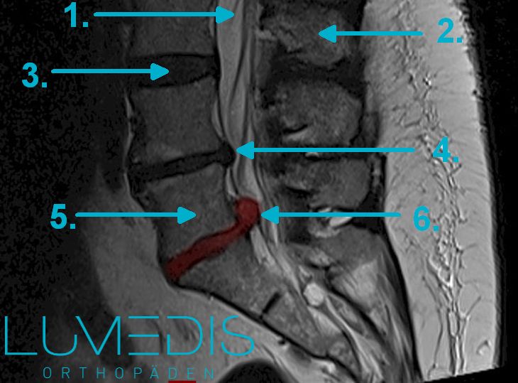 MRT von einem Bandscheibenvorfall der LWS