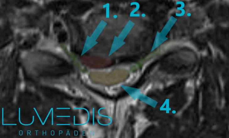 MRT eines Bandscheibenvorfalls der HWS nach rechts