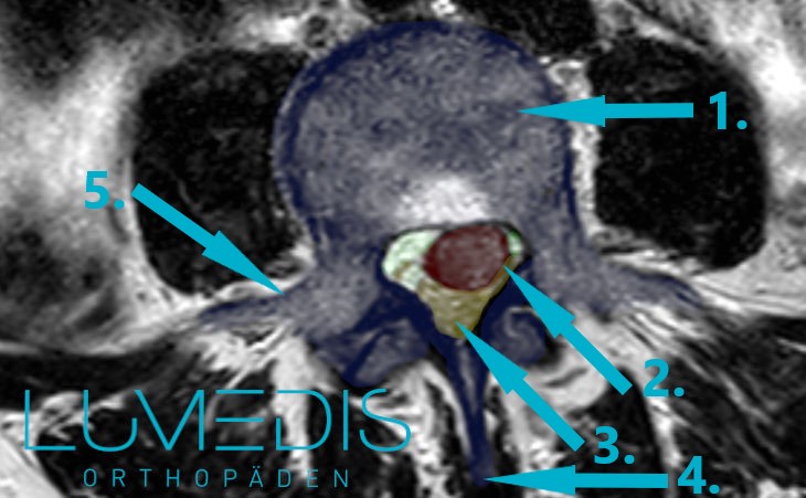 MRT eines Bandscheibenvorfall der LWS, der in den Spinalkanal gefallen ist