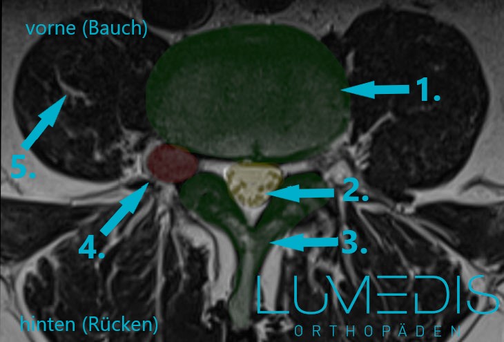 Lumedis Bandscheibenvorfall Der LWS Lumedis Ihre 