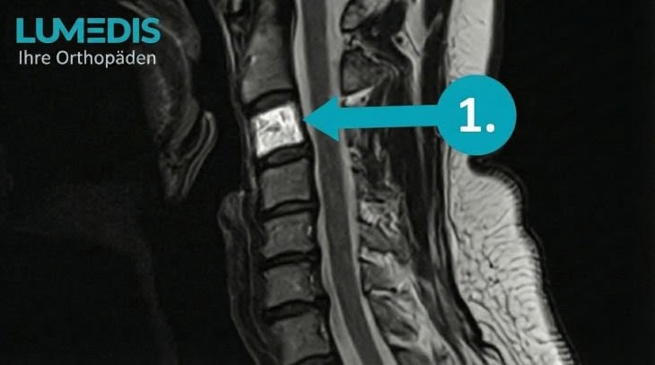 MRT eines atypischen Hämangioms im Wirbelkörper C3 der Halswirbelsäule (HWS)