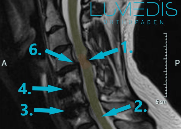 MRT einer Spinalkanalstenose der HWS