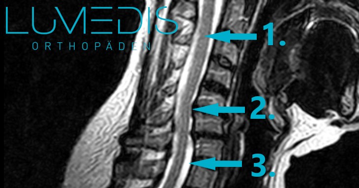 MRT einer Spinalkanalstenose der HWS