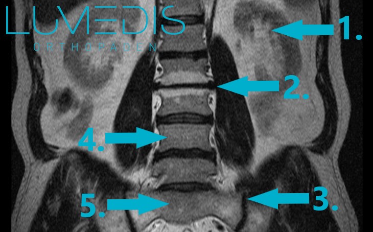 Osteochondrose der LWS