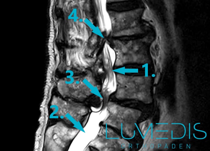 MRT einer Spinalkanalstenose der LWS