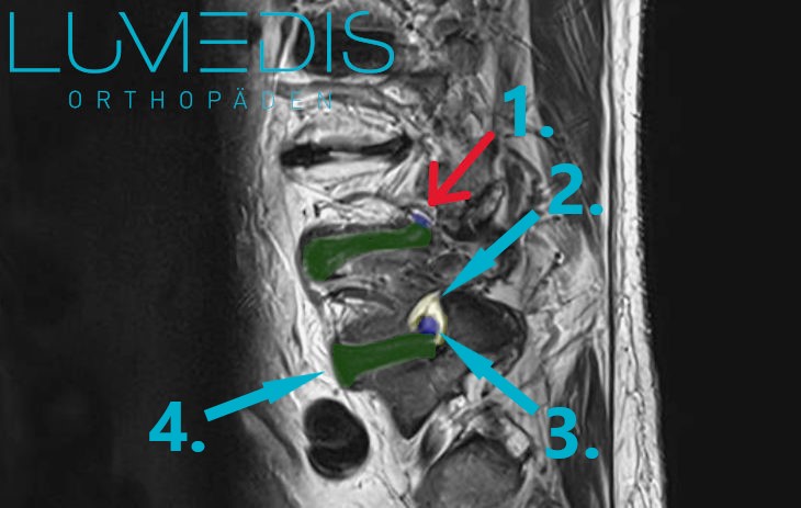 MRT einer Neuroforamenstenose L4/5 rechts