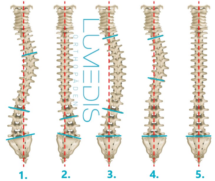 Abbildung verschiedener Formen der Skoliose