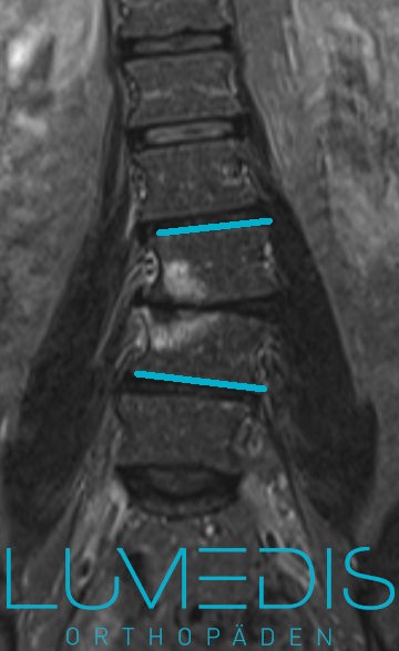 Skoliose der LWS - MRT LWS