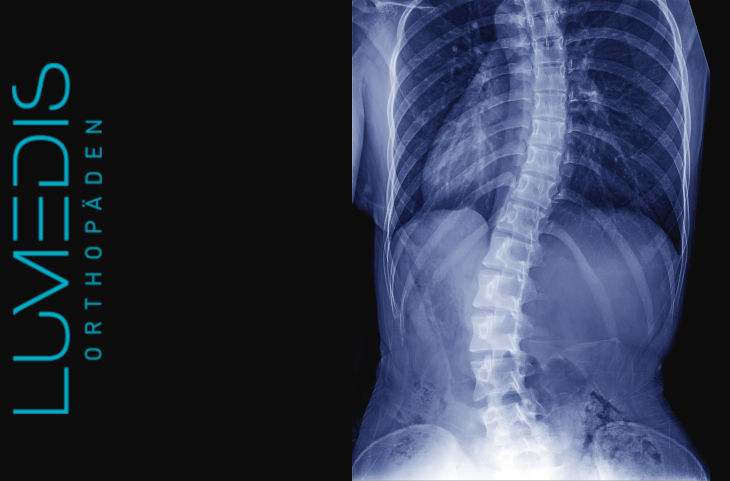Röntgen Skoliose Röntgen Skoliose