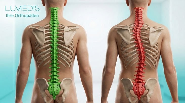 Abbildung einer Skoliose mit Cobb Winkel Abbildung einer Skoliose mit Cobb Winkel